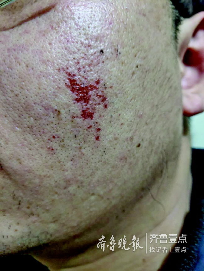 济南一市民网购男士面部脱毛膏一抹竟破了相咋办