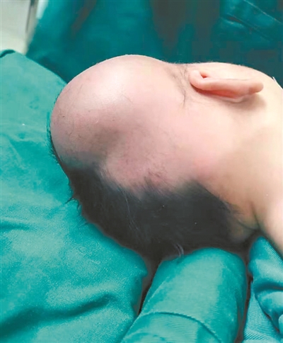 婴儿急产头部着地出生5天勇闯5关